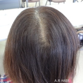 つむじ割れ 女性増毛1